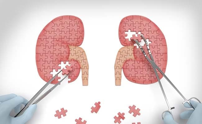 Researchers have identified a way to determine damage risks in donated kidneys.(Representational Photo)