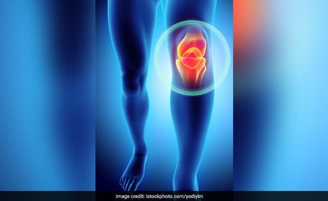Weight loss can reduce knee osteoarthritis pain by 50%