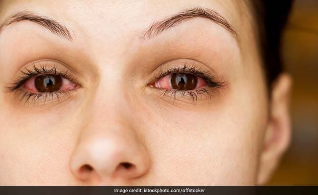 Allergic conjunctivitis is characterised with the inflammation of the eyes